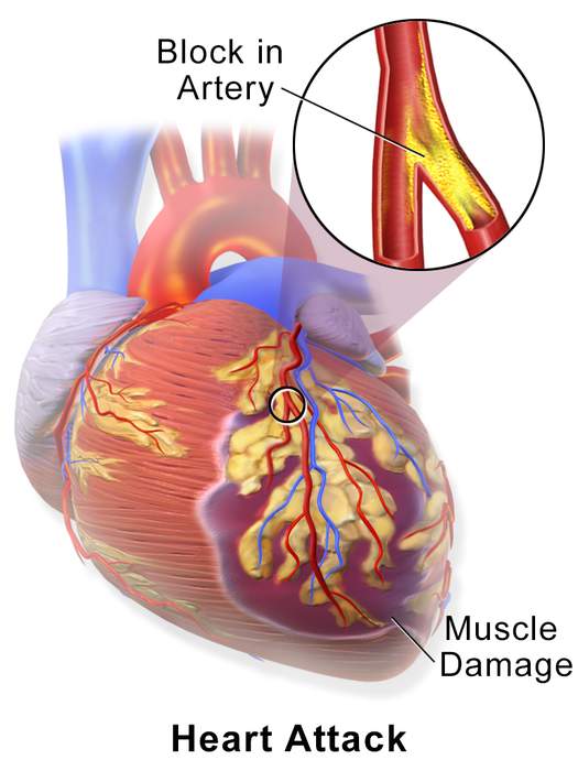 Myocardial infarction: Interruption of cardiac blood supply