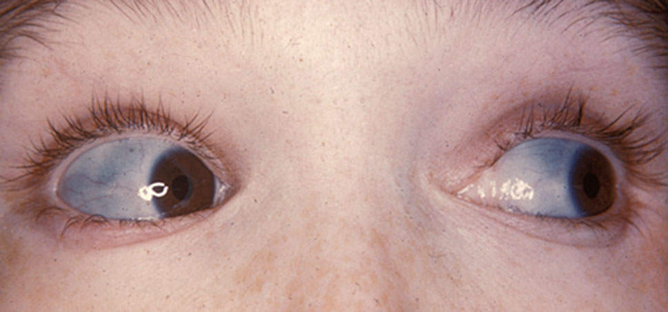 Osteogenesis imperfecta: Group of genetic disorders